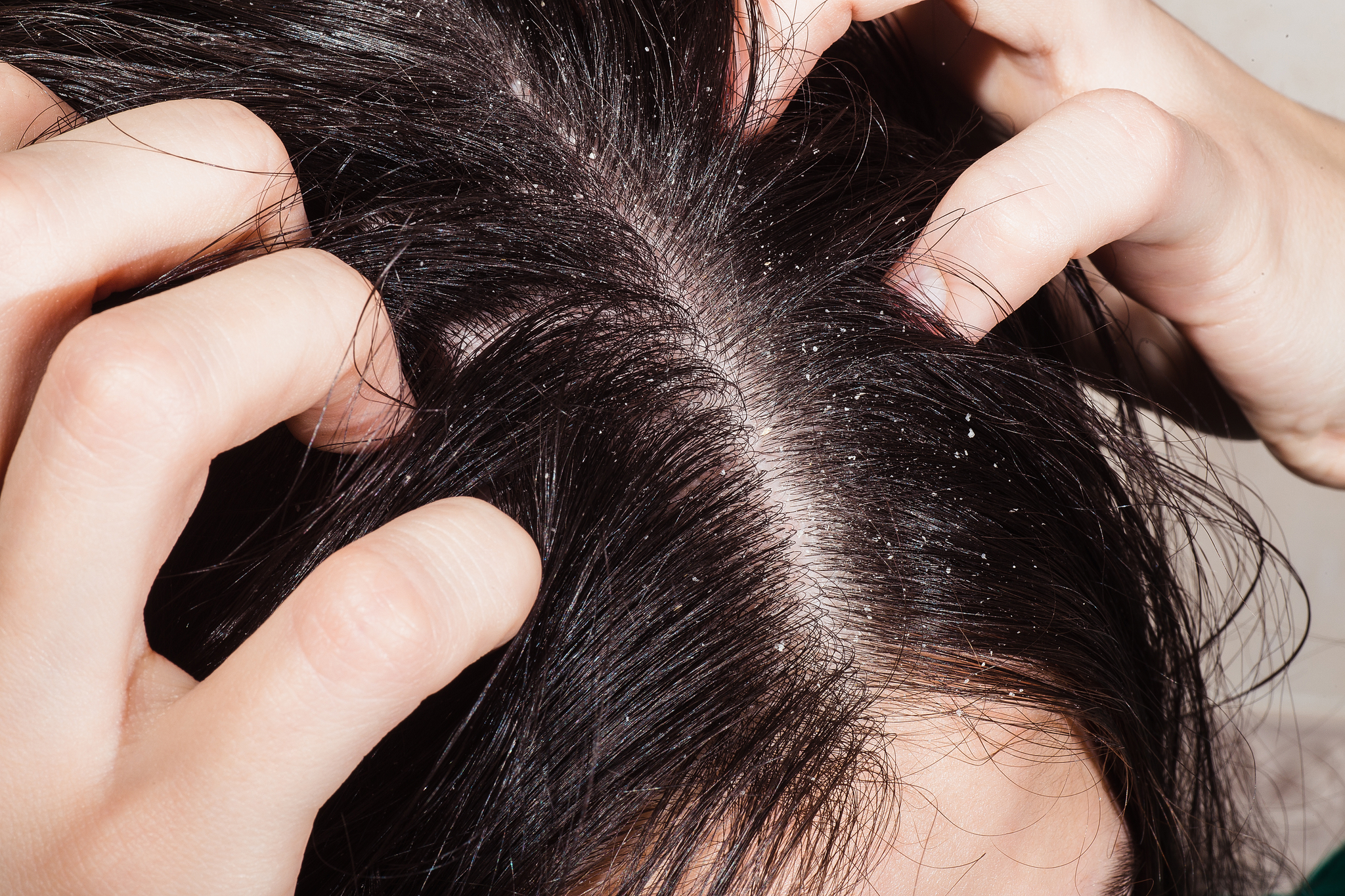 How to Get Rid Of Dry Scalp Fast