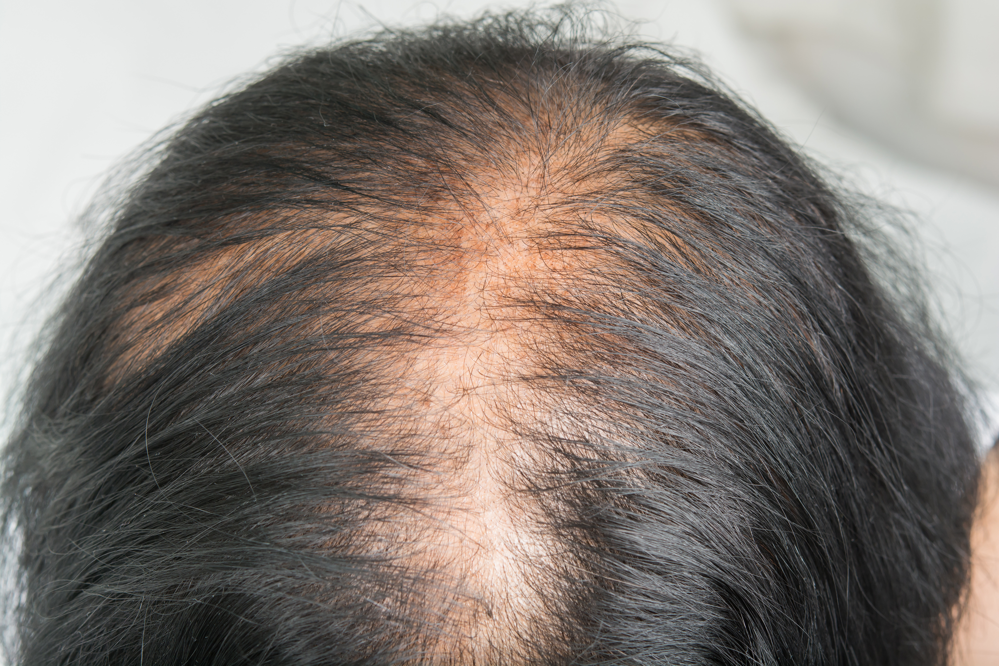 How to Prevent Dry Scalp Hair Loss
